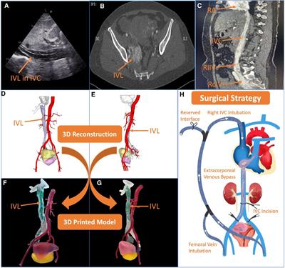 Case report: Cardiac metastatic uterine intravenous leiomyomatosis excision with extracorporeal venous shunt under the guidance of 3-dimensional printing